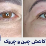 کاهش چین و چروک