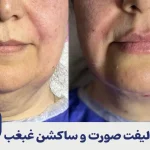 لیفت صورت و ساکشن غبغب