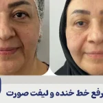 رفع خط خنده و لیفت صورت
