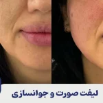 لیفت صورت و جوانسازی
