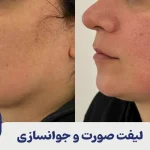 لیفت صورت و جوانسازی