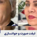 لیفت صورت و جوانسازی