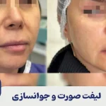لیفت صورت و جوانسازی