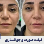 لیفت صورت و جوانسازی