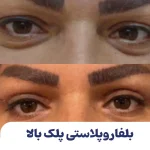 بلفاروپلاستی پلک بالا