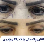 بلفاروپلاستی پلک بالا و پایین
