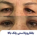 بلفاروپلاستی پلک بالا