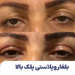 بلفاروپلاستی پلک بالا
