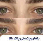 بلفاروپلاستی پلک بالا