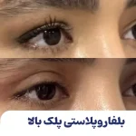 بلفاروپلاستی پلک بالا