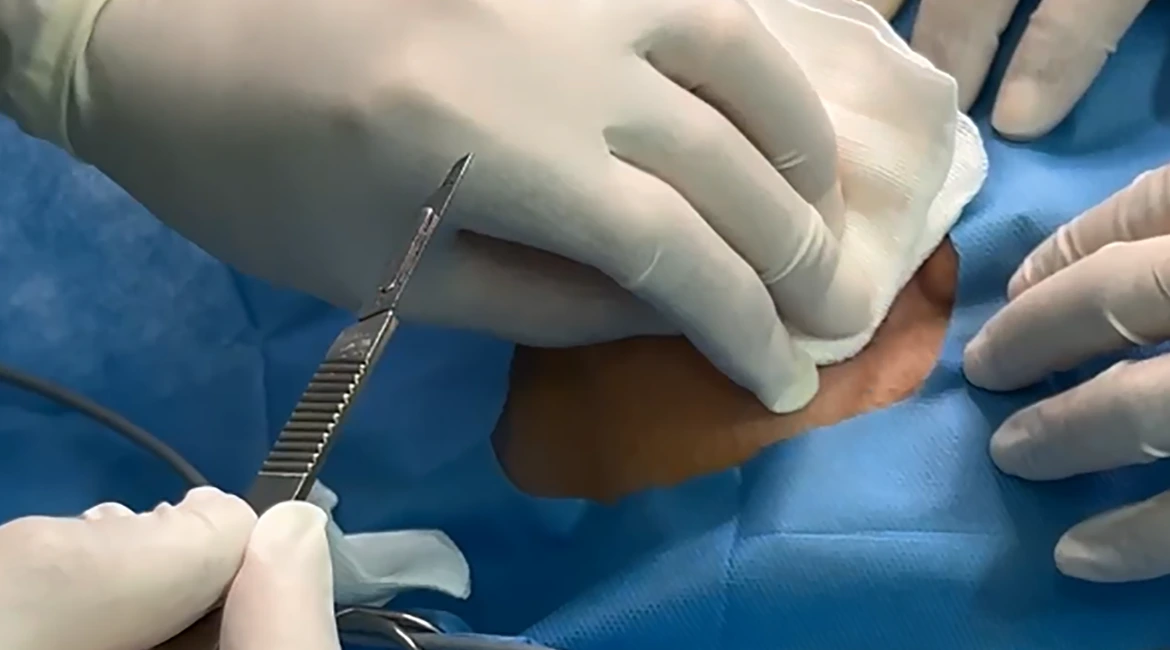 Breast-cancer-surgery_11zon