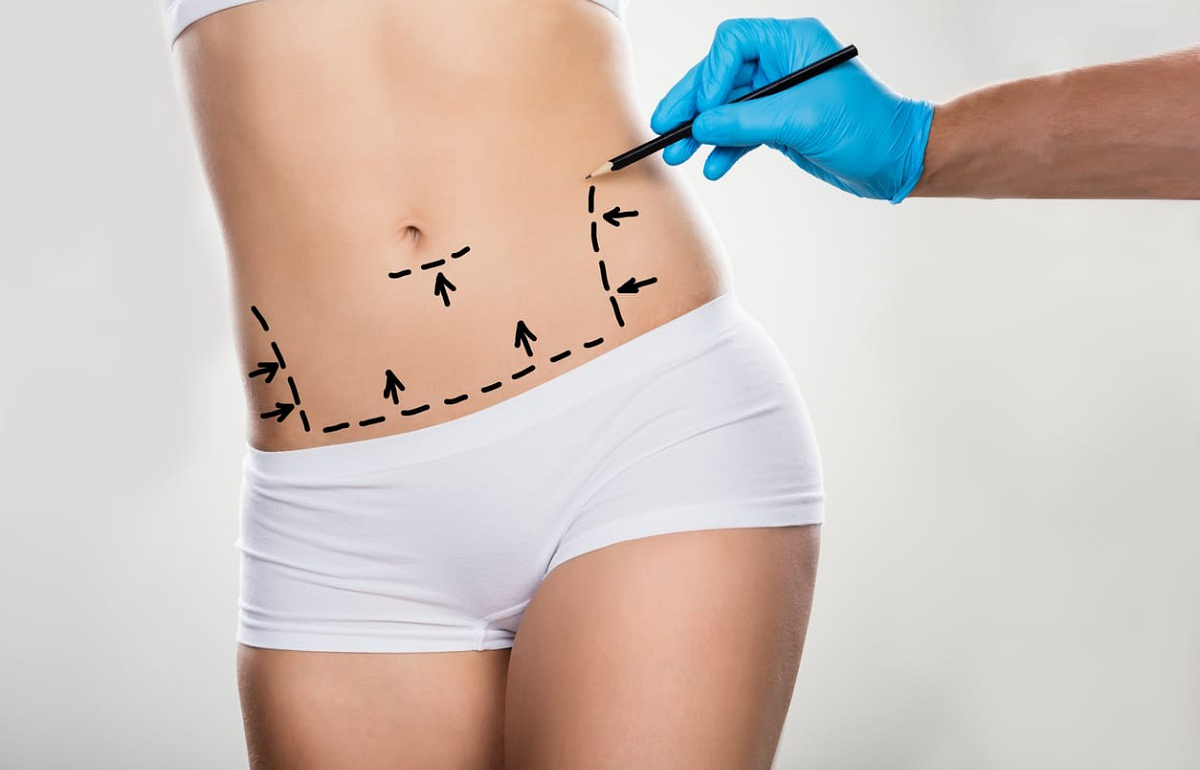 liposuction