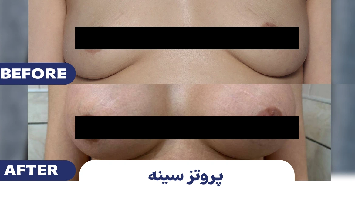 پروتز (1)