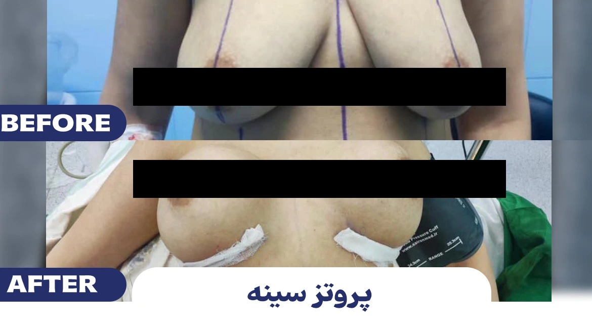 پروتز (2)
